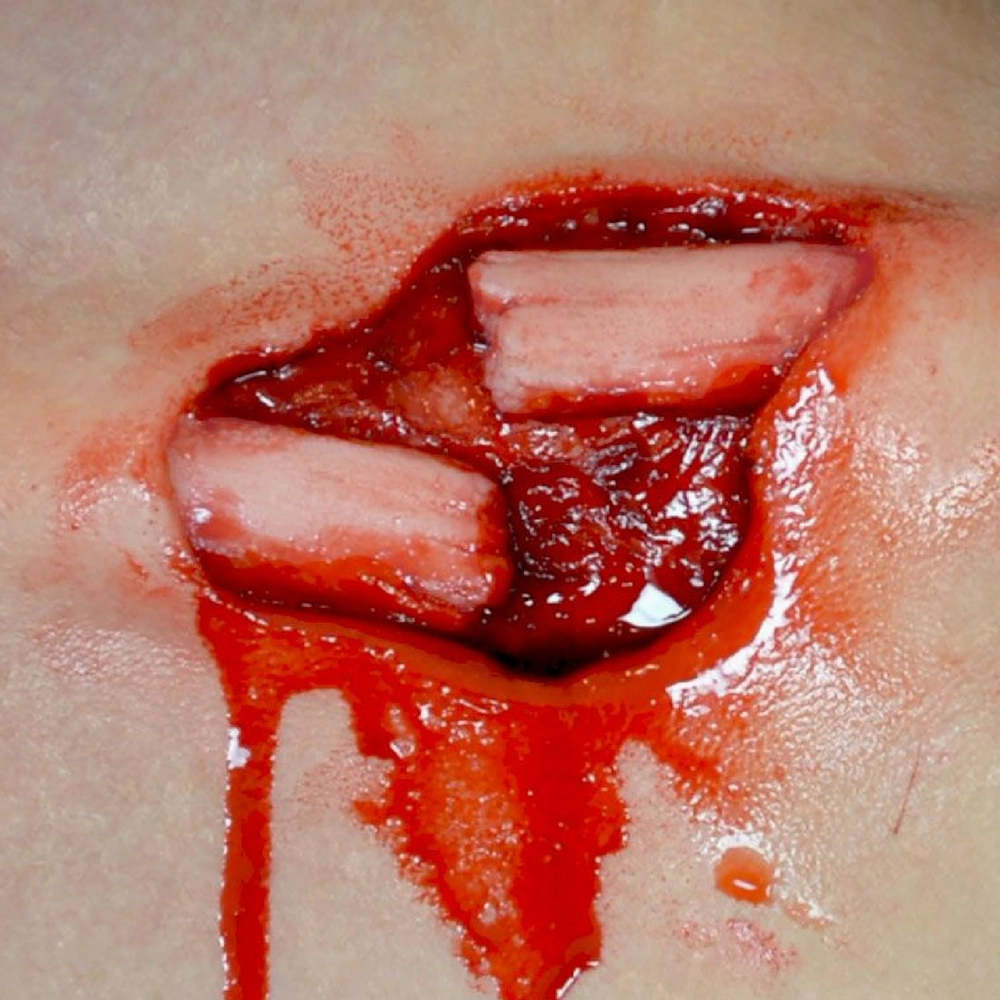 Out of Kit Compound Fracture 2